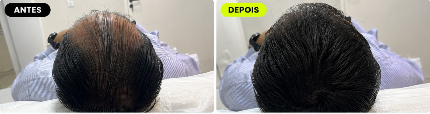 Antes e depois de tratamento capilar M Hair