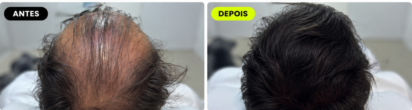 Evolução de tratamento capilar M Hair